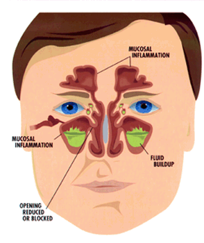 Antibiotics and nasal steroids for acute sinusitis
